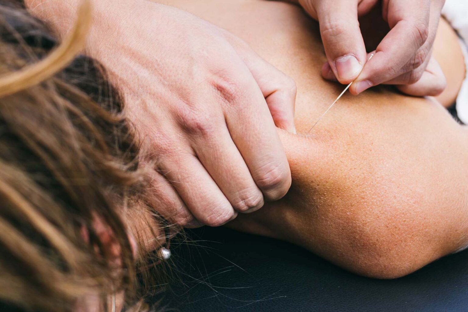 Trigger Point Dry Needling Therapy Near Me RET Physical Therapy